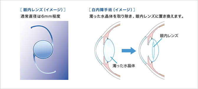 眼内レンズ（イメージ）通常直径は6mm程度　白内障手術（イメージ）濁った水晶体を取り除き、眼内レンズに置き換えます。