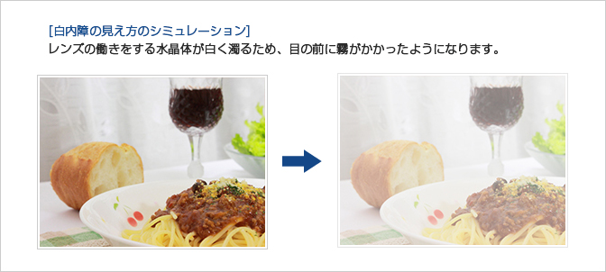 眼内レンズ（イメージ）通常直径は6mm程度　白内障手術（イメージ）濁った水晶体を取り除き、眼内レンズに置き換えます。