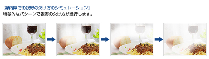 眼内レンズ（イメージ）通常直径は6mm程度　白内障手術（イメージ）濁った水晶体を取り除き、眼内レンズに置き換えます。