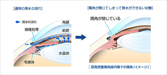 眼内レンズ（イメージ）通常直径は6mm程度　白内障手術（イメージ）濁った水晶体を取り除き、眼内レンズに置き換えます。